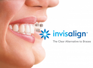 invisalign header