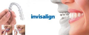 invisalign braces