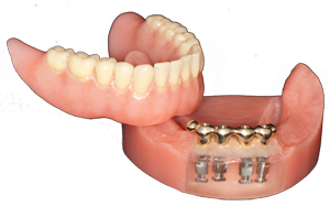 Dental Implants