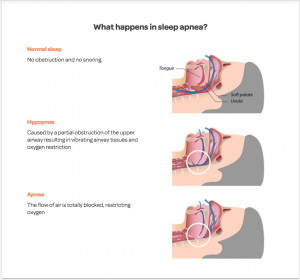 sleep apnea treatments