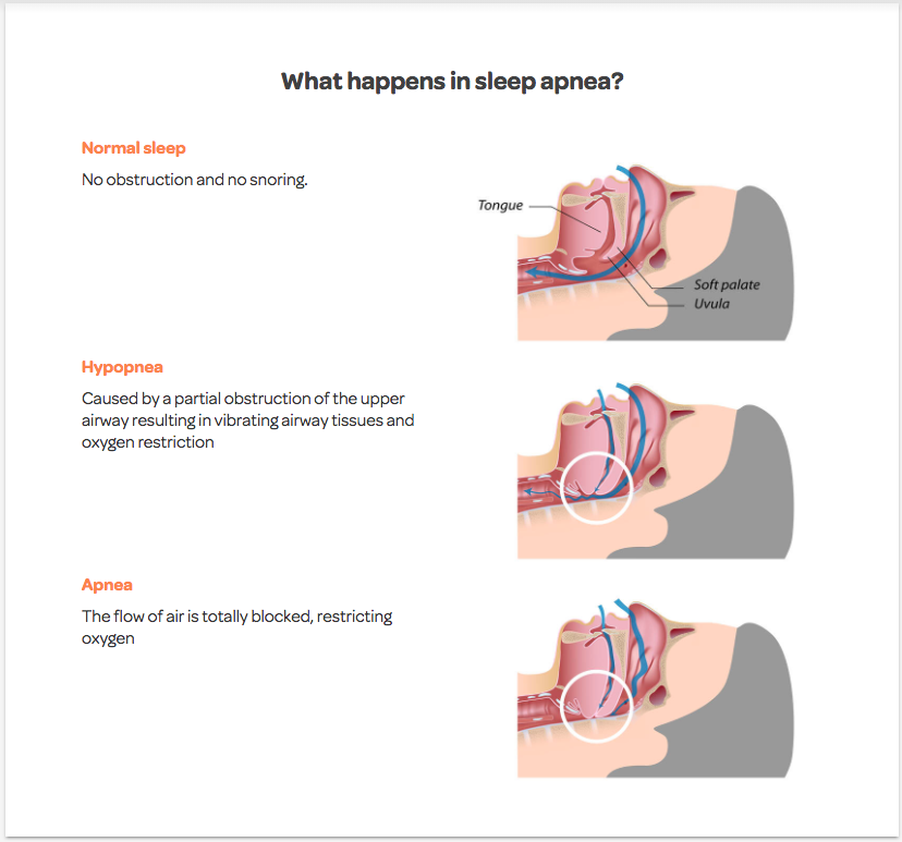 sleep apnea treatments